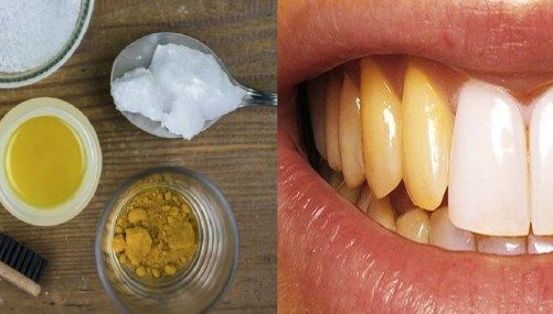Tips Mudah Hilangkan Plak Pada Gigi, Hanya Dengan Bahan Dapur